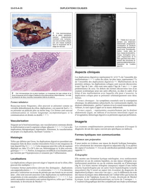 33-015-A-35 DUPLICATIONS COLIQUES Radiodiagnostic 
Formes tubulaires 
Beaucoup moins fréquentes, elles peuvent se présenter comme un 
véritable dédoublement du côlon, duplications « en canon de fusil » [16], 
ou présenter un pédicule plus ou moins long. Ces formes sont souvent 
communicantes et restent longtemps asymptomatiques si la 
communication est distale ou double [5, 18, 23]. 
Vascularisation 
Siégeant sur le bord mésentérique, une vascularisation commune aborde 
la malformation avant le segment colique adjacent [10, 12, 16, 18]. Ceci a des 
implications thérapeutiques importantes. Rarement, la vascularisation 
est propre à la duplication, facilitant l’exérèse [5]. 
Histologie 
Telles que définies par Gross, les duplications digestives possèdent une 
muqueuse faite de deux couches musculaires lisses et une muqueuse de 
type digestif (fig 2) [5, 8, 12, 16]. Cette muqueuse peut être celle du segment 
dupliqué ou, dans 25 à 30 % des cas, hétérotopique et, le plus souvent, 
gastrique [15, 16, 17, 19]. Parfois, la muqueuse est difficile à reconnaître parce 
que laminée par l’hyperpression et remaniée par l’inflammation. 
Localisations 
Les duplications coliques peuvent siéger n’importe où sur le côlon, elles 
peuvent être multiples [8, 16]. 
Certaines formes particulières doivent être distinguées : duplications 
cæcoappendiculaires [6, 11, 16, 17] et colorectales [5, 6, 16, 23]. Ces dernières 
peuvent s’extérioriser au niveau du périnée par une fistule ou un second 
anus ; elles sont souvent associées à des duplications ou malformations 
urogénitales et à des anomalies vertébromédullaires [4, 5, 6, 11, 13, 16, 23]. Les 
autres anomalies rencontrées sont surtout digestives, telles que l’atrésie 
intestinale, le diverticule de Meckel [5, 16]. 
Aspects cliniques 
Les duplications digestives représentent 0,1 à 0,3 % de l’ensemble des 
malformations [8, 16, 23], celles du côlon, les plus rares, représentant 7 % 
de l’ensemble des duplications digestives [18]. Malformations de la 
première enfance, les duplications coliques sont souvent découvertes 
avant l’âge de 2 ans ; elles sont rares après l’âge de 3 ans [4, 16, 18], sans 
prédominance de sexe. En dehors des formes découvertes lors d’un 
examen systématique pour une autre affection, ou dans le cadre d’un 
bilan d’une malformation avec laquelle elle peut s’associer, la 
duplication colique peut se présenter schématiquement sous deux 
formes. 
– Formes chroniques : les symptômes essentiels sont la constipation 
chronique, les phénomènes subocclusifs, les vomissements répétés, les 
douleurs abdominales ; parfois l’anémie et/ou le retard staturopondéral. 
Ailleurs, le seul signe d’appel est la masse abdominale. 
– Formes aiguës : représentées essentiellement par la douleur 
abdominale aiguë, un tableau d’occlusion intestinale aiguë ou 
d’invagination, hémorragie digestive ou péritonite aiguë par perforation. 
Imagerie 
Les examens complémentaires permettent seulement d’évoquer le 
diagnostic devant des signes souvent peu spécifiques ou indirects. 
Formes kystiques non communicantes 
Abdomen sans préparation 
Il peut mettre en évidence une masse de densité hydrique homogène, 
avec refoulement des structures digestives adjacentes (fig 3) ou parfois 
des signes d’occlusion [23]. Un cas de calcification pariétale colique a été 
rapporté [21]. 
Échographie 
Elle montre une formation kystique anéchogène, avec renforcement 
postérieur en cas de contenu liquidien, ou une masse échogène avec 
renforcement postérieur en cas de contenu mucoïde ou d’hémorragie 
(fig 4). Un liseré interne échogène (muqueux) séparé d’une limite 
externe hyperéchogène par un autre liseré hypoéchogène (couche 
musculaire) (fig 5) serait un aspect très évocateur du diagnostic de 
duplication kystique « muscular rim sign » ; ceci le différencie du reste 
des masses kystiques intra-abdominales de l’enfant telles que kystes du 
mésentère et de l’épiploon, kystes de l’ovaire, diverticule de Meckel 
kystique, kyste omphalomésentérique ou kyste de l’ouraque [1, 5]. 
L’examen échographique doit être complété par une étude systématique 
1 Vue macroscopique 
de la pièce opératoire 
(section longitudinale) 
montrant une compres-sion 
de la lumière colique 
par une masse kystique 
dont la muqueuse est le 
siège de nécrose. 
2 Vue microscopique de la paroi kystique. La muqueuse de type colique et la 
sous-muqueuse sont le siège d’oedème et de phénomènes inflammatoires ; on note 
la présence de deux couches musculaires interne et externe. 
3 Fillette de 2 ans pré-sentant 
une distension 
abdominale progressive, 
constipation et douleurs 
abdominales, évoluant de-puis 
6 mois. Tomodensito-métrie 
: mode radio de 
face,massede densité hy-drique, 
homogène occu-pant 
l’hypocondre et le 
flanc gauches avec refou-lement 
des structures di-gestives 
adjacentes etmé-dialisation 
de l’uretère 
gauche. 
page 2 
 