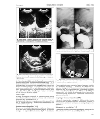 Radiodiagnostic DUPLICATIONS COLIQUES 33-015-A-35 
de l’appareil urogénital, à la recherche d’une malformation congénitale 
associée, habituellement fréquente dans les formes kystiques [5, 14]. Le 
diagnostic anténatal des duplications coliques paraît possible pour les 
formes kystiques non communicantes, grâce à la mise en évidence, lors 
d’un examen échographique, d’une formation transsonique avec 
renforcement postérieur. S’il est facile d’éliminer une dilatation des 
voies urinaires supérieures, il paraît beaucoup plus difficile, voire 
impossible, d’éliminer l’hypothèse d’un kyste ovarien ou mésentérique, 
ou d’un diverticule de Meckel kystique. 
Transit baryté 
Il montre une empreinte extrinsèque sur le segment colique adjacent 
avec refoulement des anses digestives, parfois un arrêt complet de la 
progression de la colonne barytée (fig 6). 
La duplication kystique n’est presque jamais opacifiée ; quand elle l’est, 
elle est toujours secondaire à une perforation inflammatoire avec 
ulcération et hémorragie [5, 18]. 
Examen tomodensitométrique (TDM) 
Il montre une formation kystique, de taille variable, avec réhaussement 
de la paroi après injection intraveineuse de produit de contraste, 
contiguë à un segment d’intestin normal (fig 7) [5] . La présence 
d’hémorragie intrakystique peut réaliser l’aspect d’une masse tissulaire 
ou d’une tumeur nécrosée [3]. La localisation de la duplication par 
rapport au tube digestif et l’absence de contact avec les autres organes 
abdominaux sont des éléments importants du diagnostic différentiel 
avec les autres formations kystiques intra-abdominales. La TDM peut 
également être utile dans la surveillance évolutive, en détectant 
d’éventuels signes de dégénérescence : apparition de zones denses ou 
épaississement pariétal [3]. 
Imagerie par résonance magnétique (IRM) 
Elle paraît très utile dans le diagnostic différentiel des formes 
colorectales avec les masses présacrées rétrorectales, telles que le 
neuroblastome, le tératome kystique ou la méningocèle présacrée 
antérieure [5]. 
Scintigraphie au pertechnétate 99mTc 
Elle permet le repérage de la muqueuse hétérotopique gastrique au sein 
de la duplication en montrant des zones d’hyperfixation [3, 5, 17]. 
4 Même patiente. Échographie abdominale (coupe longitudinale passant par 
l’hypocondre gauche) : volumineuse formation kystique, partiellement cloisonnée, à 
contours lobulés et à contenu échogène avec renforcement postérieur. 
5 Même patiente. Échographie abdominale (coupe longitudinale postérieure pas-sant 
par la fosse lombaire gauche) : formation kystique dont la paroi est faite de trois 
couches : interne et externe échogènes et médiane hypoéchogène « muscular rim 
sign » (flèches). 
6 Même patiente. Lavement baryté montrant une compression extrinsèque mar-quée 
sur le côlon descendant, empêchant l’opacification du segment colique d’amont. 
7 Même patiente. Examen tomodensitométrique avec contraste : masse de den-sité 
liquidienne, partiellement cloisonnée, à contours lobulés avec rehaussement de 
sa paroi après injection de produit de contraste. 
page 3 
 
