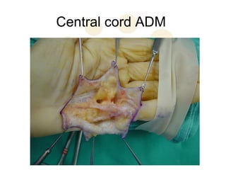 Central cord ADM
 
