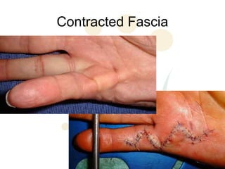 Contracted Fascia
 