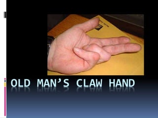 OLD MAN’S CLAW HAND
 