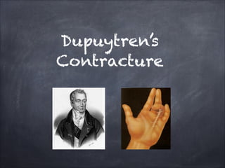 Dupuytren’s
Contracture

 