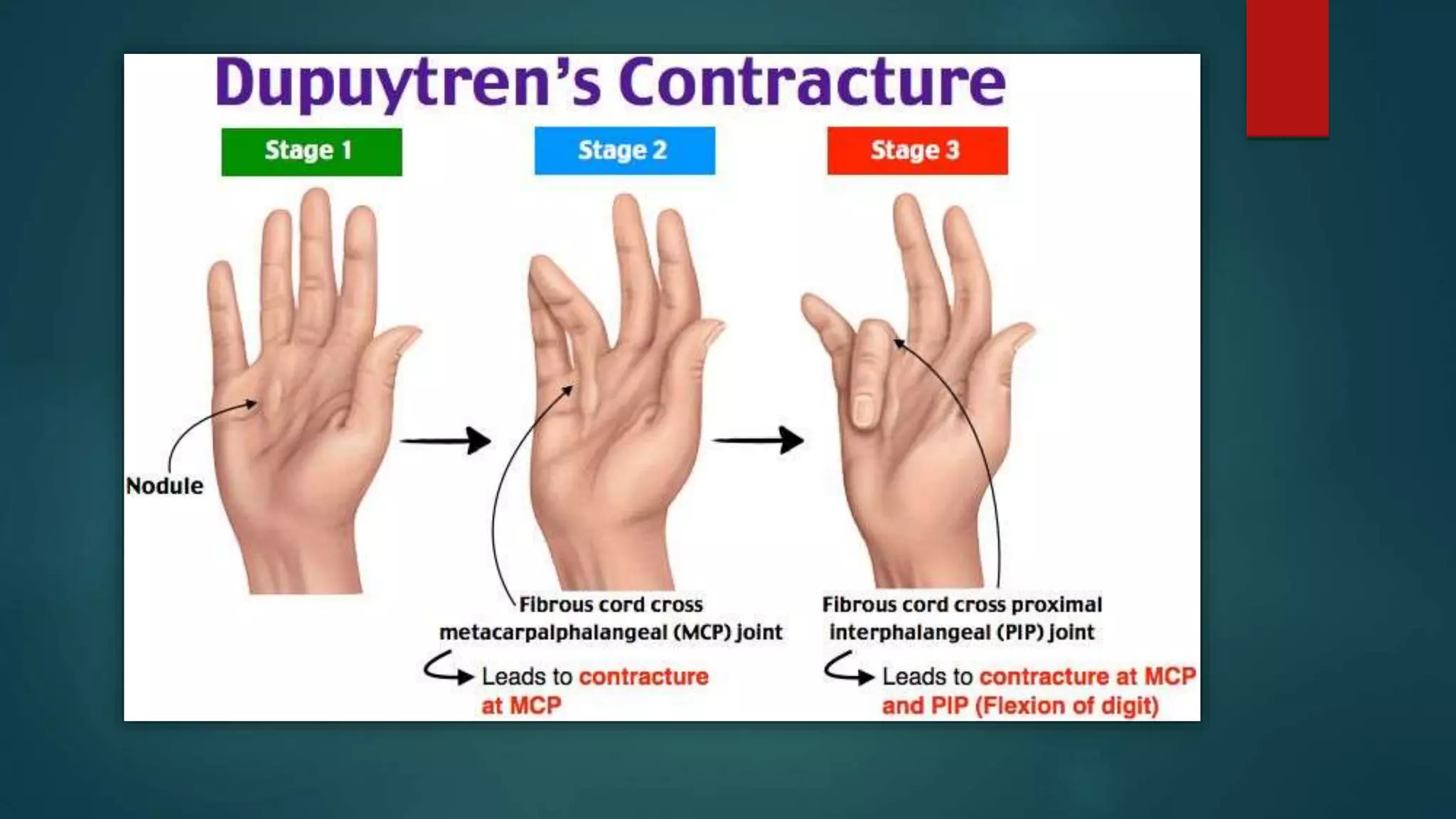 Dupuytren s Disease pptx dupuytren-s-disease-pptx