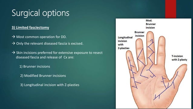 Racket Incision Hand Dupuytren’s Disease.pptx