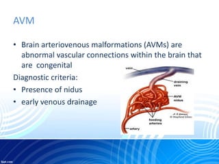 Dural arteriovenous fistula & AVM | PPTX