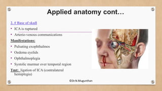 2. # Base of skull
• ICA is ruptured
• Arterio-venous communications
Manifestations:
• Pulsating exophthalmos
• Oedema eyelids
• Ophthalmoplegia
• Systolic murmur over temporal region
Tmt: ligation of ICA (contralateral
hemiplegia)
Applied anatomy cont…
©Dr.N.Mugunthan
 