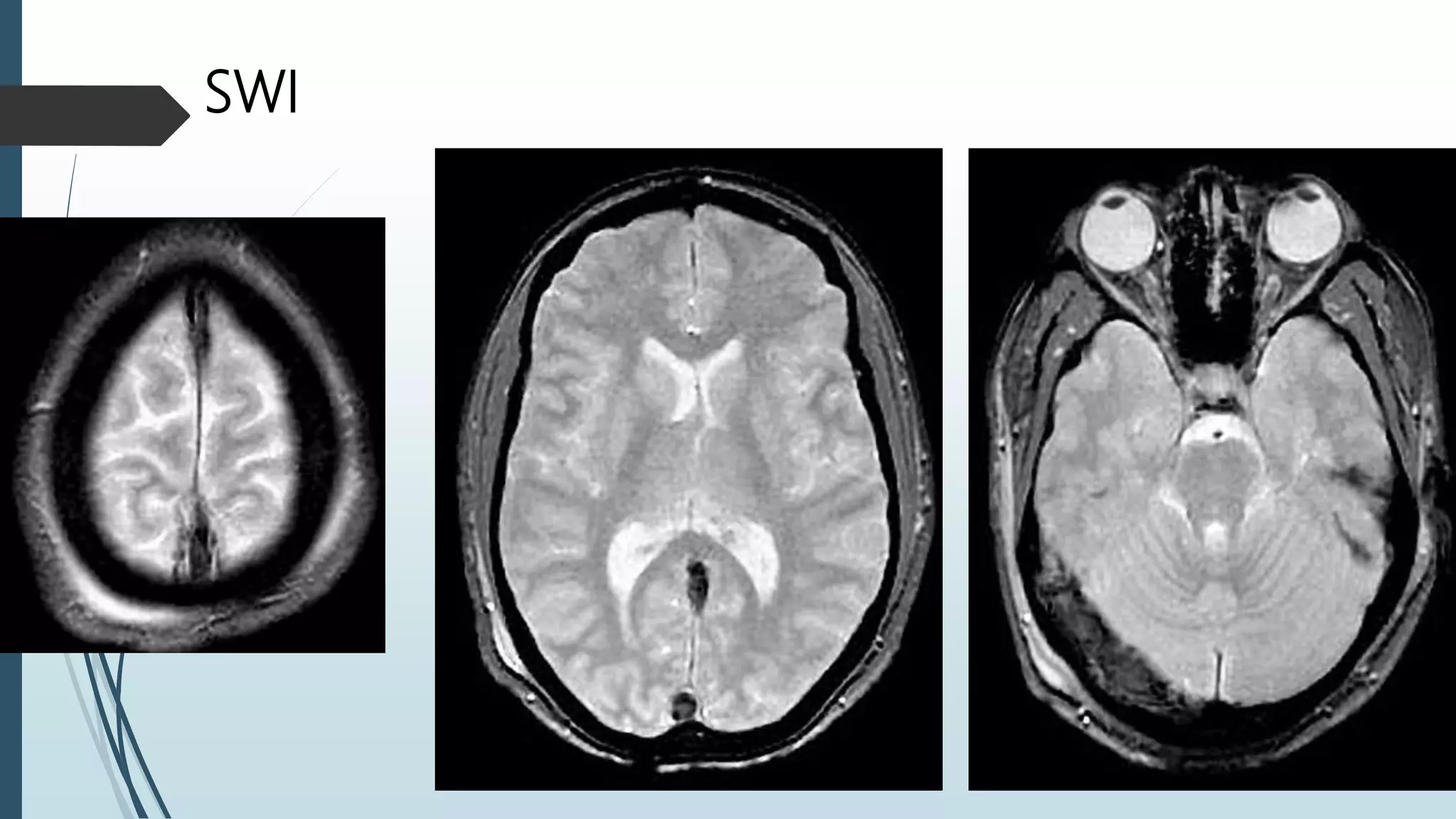 Dvt Vision Dural venous sinus thrombosis for Radiology & Imaging | PPTX