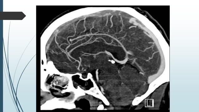 Dural venous sinus thrombosis for Radiology & Imaging | PPTX | Ear ...