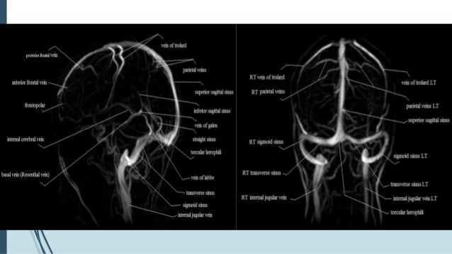 Dural Venous Sinus Thrombosis For Radiology Imaging Dural Venous Sinus Thrombosis For Radiology Imaging