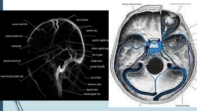 Dural Venous Sinus Thrombosis For Radiology Imaging Dural Venous Sinus Thrombosis For Radiology Imaging