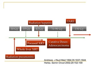 35 Gy 
70-90 Gy 
Curative Doses: Adenocarcinoma 
Radiation hepatitis 
Whole liver XRT 
TARE 
150 Gy 
Andrews. J Nucl Med 1994;35:1637-1644 Herba. Semin Oncol 2002;29:152-159 
Radiation pneumonitis 
30 Gy 
43 Gy 
Focused XRT  