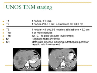 UNOS TNM staging 
T1 1 nodule < 1.9cm 
T2 1 nodule 2.0-5.0 cm; 2-3 nodules all < 3.0 cm 
T3 1 nodule > 5 cm; 2-3 nodules at least one > 3.0 cm 
T4a 4 or more nodules 
T4b T2,T3,T4a plus vascular involvement 
N1 Regional nodes involved 
M1 Metastatic disease including extrahepatic portal or hepatic vein involvement  