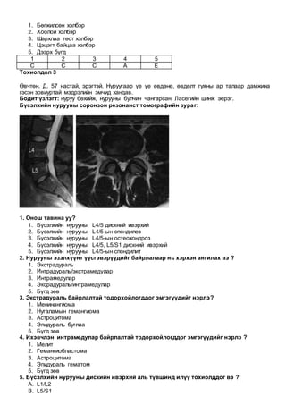 1. Бөгжилсөн хэлбэр
2. Хоолой хэлбэр
3. Шархлаа төст хэлбэр
4. Цэцэгт байцаа хэлбэр
5. Дээрх бүгд
1 2 3 4 5
C C C A E
Тохиолдол 3
Өвчтөн. Д. 57 настай, эрэгтэй. Нуруугаар үе үе өвдөнө, өвдөлт гуяны ар талаар дамжина
гэсэн зовиуртай мэдрэлийн эмчид хандав.
Бодит үзлэгт: нуруу бөхийж, нурууны булчин чангарсан, Ласегийн шинж эерэг.
Бүсэлхийн нурууны соронзон резонанст томографийн зураг:
1. Онош тавина уу?
1. Бүсэлхийн нурууны L4/5 дискний ивэрхий
2. Бүсэлхийн нурууны L4/5-ын спондилез
3. Бүсэлхийн нурууны L4/5-ын остеохондроз
4. Бүсэлхийн нурууны L4/5, L5/S1 дискний ивэрхий
5. Бүсэлхийн нурууны L4/5-ын спондилит
2. Нурууны эзэлхүүнт үүсгэвэрүүдийг байрлалаар нь хэрхэн ангилах вэ ?
1. Экстрадураль
2. Интрадураль/экстрамедулар
3. Интрамедулар
4. Эксрадураль/интрамедулар
5. Бүгд зөв
3. Экстрадураль байрлалтай тодорхойлогддог эмгэгүүдийг нэрлэ?
1. Mенинангиома
2. Нугаламын гемангиома
3. Астроцитома
4. Эпидураль буглаа
5. Бүгд зөв
4. Ихэвчлэн интрамедулар байрлалтай тодорхойлогддог эмгэгүүдийг нэрлэ ?
1. Мелит
2. Гемангиобластома
3. Астроцитома
4. Эпидураль гематом
5. Бүгд зөв
5. Бүсэлхийн нурууны дискийн ивэрхий аль түвшинд илүү тохиолддог вэ ?
A. L1/L2
B. L5/S1
 