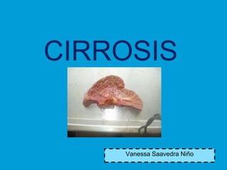 CIRROSIS


    Vanessa Saavedra Niño
 