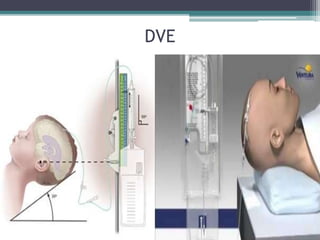 DVE, DVP, DLE E PVC | PPTX