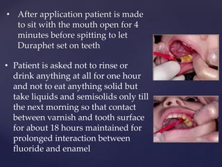 • After application patient is made
to sit with the mouth open for 4
minutes before spitting to let
Duraphet set on teeth
• Patient is asked not to rinse or
drink anything at all for one hour
and not to eat anything solid but
take liquids and semisolids only till
the next morning so that contact
between varnish and tooth surface
for about 18 hours maintained for
prolonged interaction between
fluoride and enamel
 