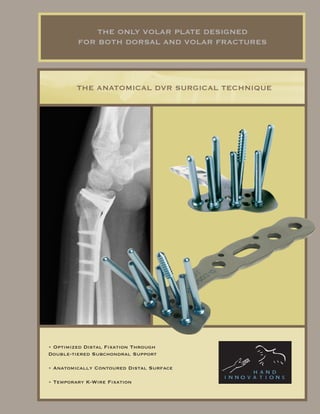 THE ONLY VOLAR PLATE DESIGNED
         FOR BOTH DORSAL AND VOLAR FRACTURES




         THE ANATOMICAL DVR SURGICAL TECHNIQUE




• Optimized Distal Fixation Through
Double-tiered Subchondral Support

• Anatomically Contoured Distal Surface

• Temporary K-Wire Fixation
 