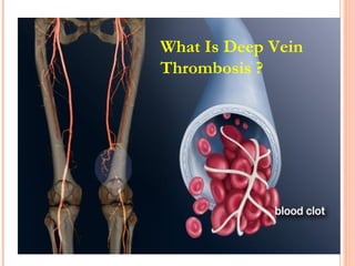 What Is Deep Vein
Thrombosis ?
 