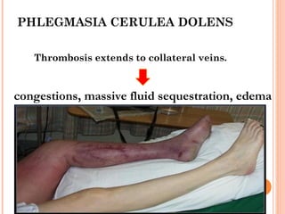 PHLEGMASIA CERULEA DOLENS

   Thrombosis extends to collateral veins.



congestions, massive fluid sequestration, edema
 