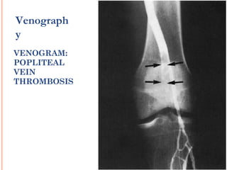 Venograph
y
VENOGRAM:
POPLITEAL
VEIN
THROMBOSIS
 