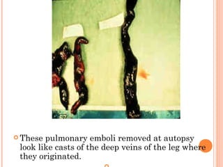  These pulmonary emboli removed at autopsy
 look like casts of the deep veins of the leg where
 they originated.
 