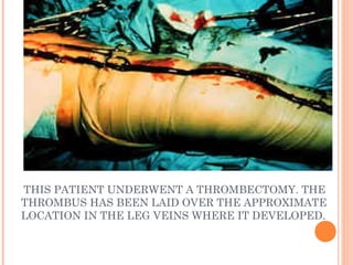 THIS PATIENT UNDERWENT A THROMBECTOMY. THE
THROMBUS HAS BEEN LAID OVER THE APPROXIMATE
LOCATION IN THE LEG VEINS WHERE IT DEVELOPED.
 