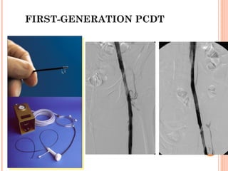FIRST-GENERATION PCDT
 