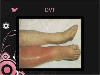 Dvt | PPT