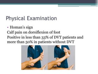 Physical Examination 
• Homan’s sign 
Calf pain on dorsiflexion of foot 
Positive in less than 33% of DVT patients and 
more than 50% in patients without DVT 
 