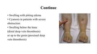 Continue
• Swelling with pitting edema
• Cyanosis in patients with severe
obstruction
• Swelling below the knee
(distal deep vein thrombosis)
or up to the groin (proximal deep
vein thrombosis)
 