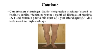 Continue
• Compression stockings: Elastic compression stockings should be
routinely applied “beginning within 1 month of diagnosis of proximal
DVT and continuing for a minimum of 1 year after diagnosis.” Most
trials used knee-high stockings.
 