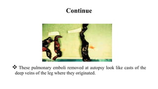 Continue
 These pulmonary emboli removed at autopsy look like casts of the
deep veins of the leg where they originated.
 