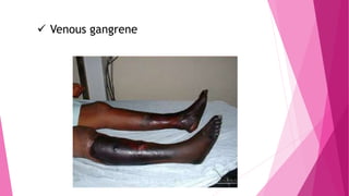  Venous gangrene
 