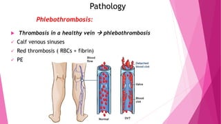 Pathology
 Thrombosis in a healthy vein  phlebothrombosis
 Calf venous sinuses
 Red thrombosis ( RBCs + fibrin)
 PE
Phlebothrombosis:
 