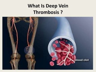 DVT, definitions, clinical presentation, complications | PPTX
