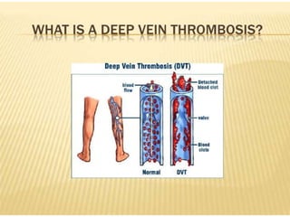 Dvt Example DEEP VEIN THROMBOSIS DVT | PPT