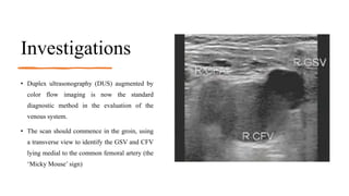 Gsv Course Radiology Varicose Veins and Deep Vein Thrombosis | PPTX
