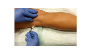 Tromboject Injection Varicose Veins and Deep Vein Thrombosis | PPTX