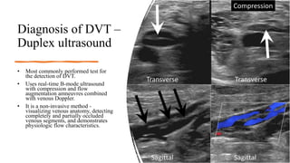 Varicose Veins and Deep Vein Thrombosis | PPTX