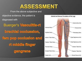 From the above subjective and
objective evidence, the patient is
diagnosed with
Buerger's
 