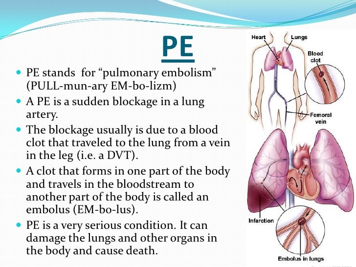 DVT, PE and Stroke What's the Difference?
