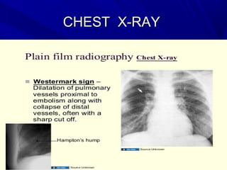 CHEST X-RAYCHEST X-RAY
 