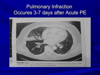 Pulmonary InfractionPulmonary Infraction
Occures 3-7 days after Acute PEOccures 3-7 days after Acute PE
 
