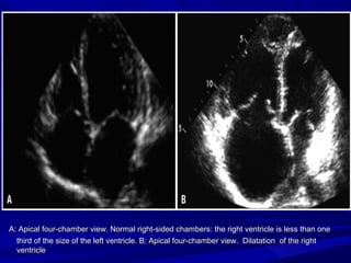 A: Apical four-chamber view. Normal right-sided chambers: the right ventricle is less than oneA: Apical four-chamber view. Normal right-sided chambers: the right ventricle is less than one
third of the size of the left ventricle. B: Apical four-chamber view. Dilatation of the rightthird of the size of the left ventricle. B: Apical four-chamber view. Dilatation of the right
ventricleventricle
 