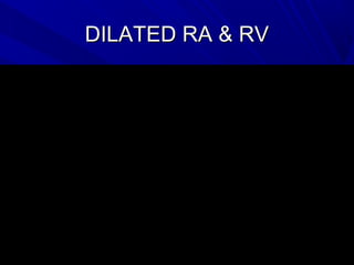 DILATED RA & RVDILATED RA & RV
 