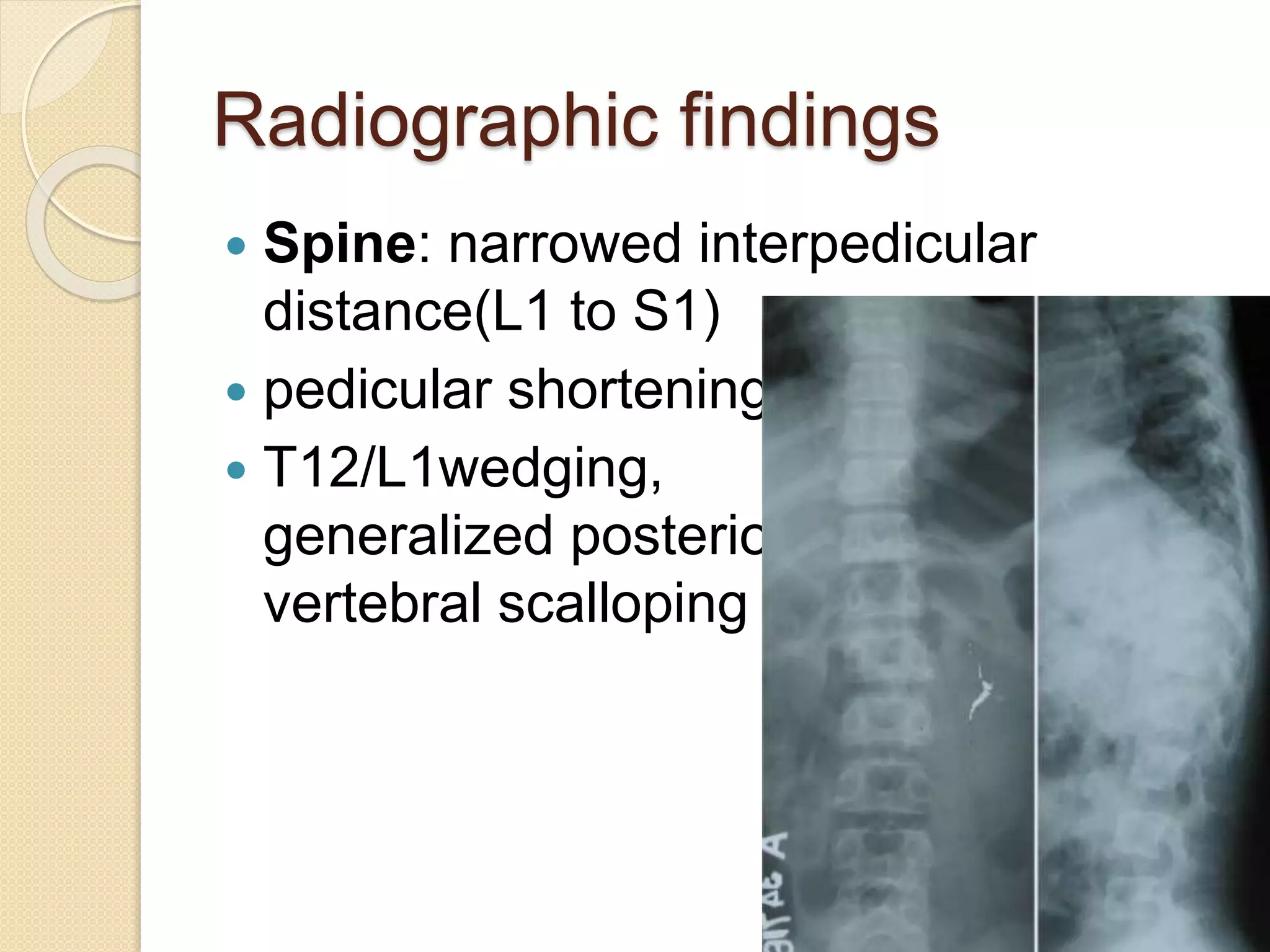 Radiographic findings 
 Spine: narrowed interpedicular 
distance(L1 to S1) 
 pedicular shortening 
 T12/L1wedging, 
generalized posterior 
vertebral scalloping 
 