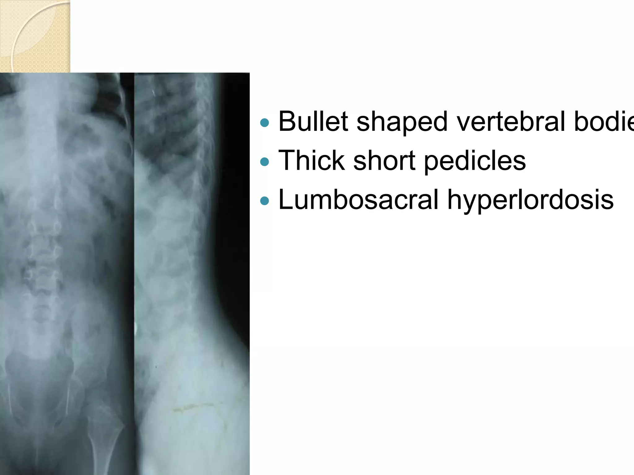  Bullet shaped vertebral bodies 
 Thick short pedicles 
 Lumbosacral hyperlordosis 
 