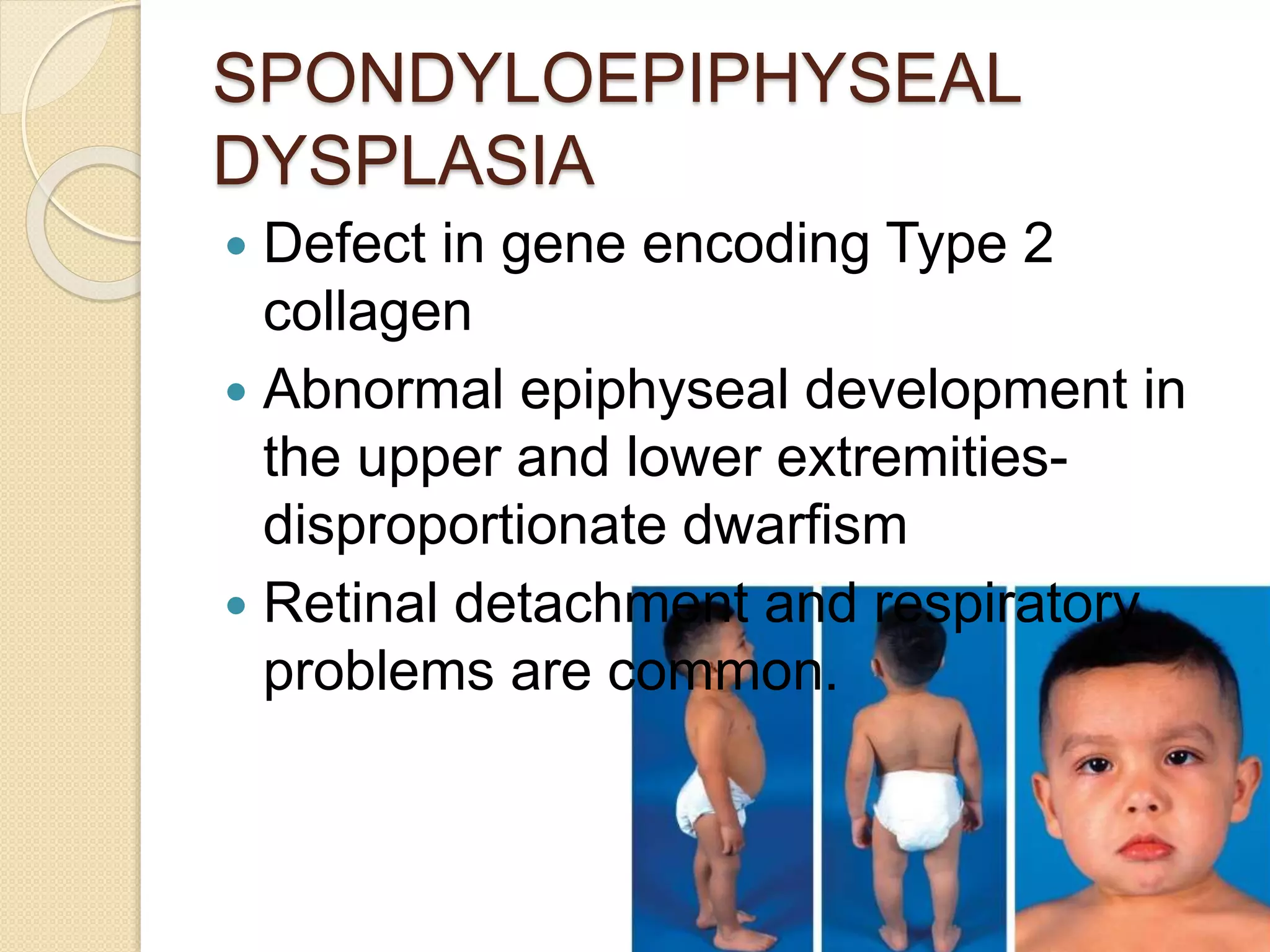 SPONDYLOEPIPHYSEAL 
DYSPLASIA 
 Defect in gene encoding Type 2 
collagen 
 Abnormal epiphyseal development in 
the upper and lower extremities-disproportionate 
dwarfism 
 Retinal detachment and respiratory 
problems are common. 
 