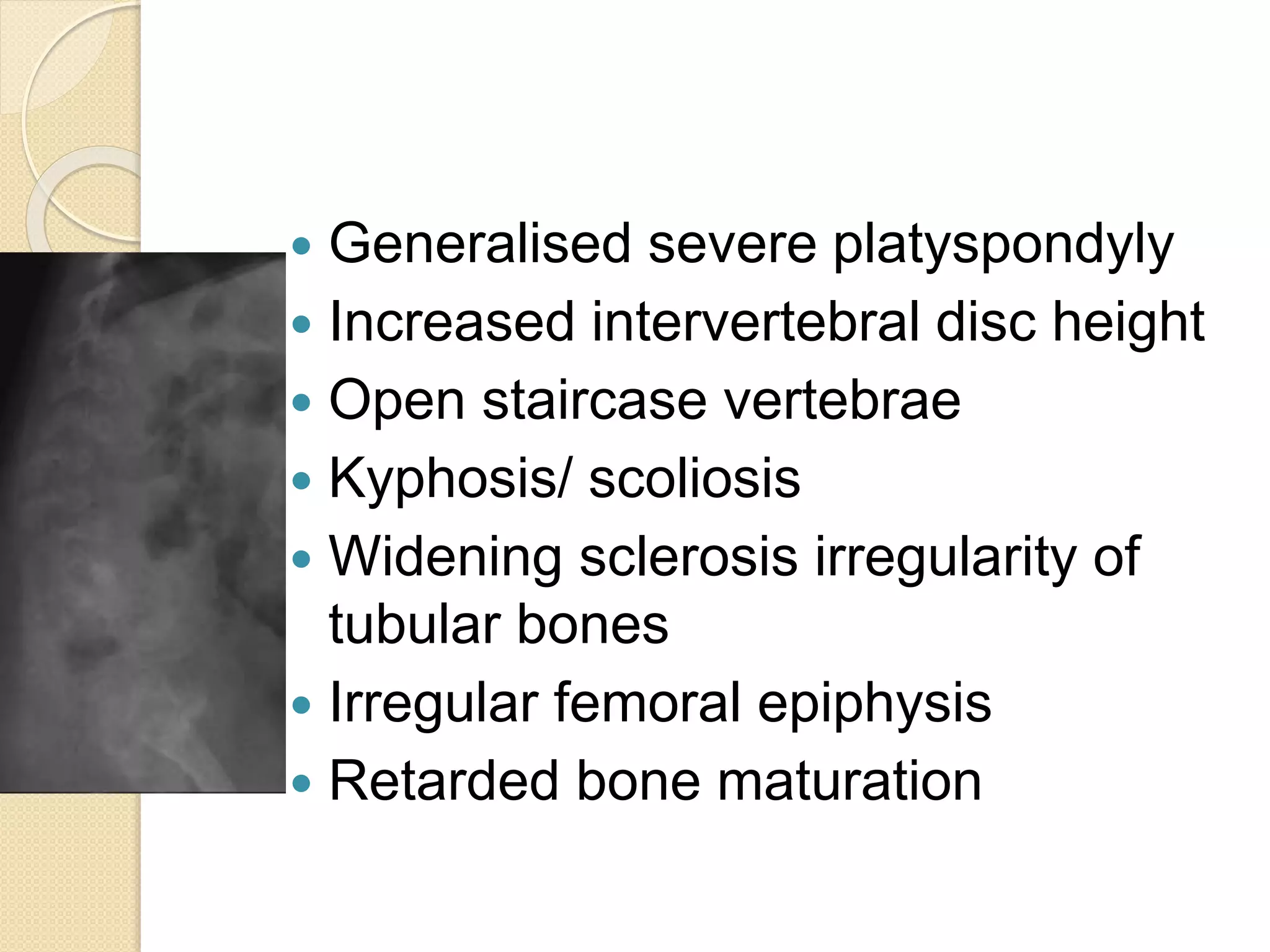  Generalised severe platyspondyly 
 Increased intervertebral disc height 
 Open staircase vertebrae 
 Kyphosis/ scoliosis 
 Widening sclerosis irregularity of 
tubular bones 
 Irregular femoral epiphysis 
 Retarded bone maturation 
 