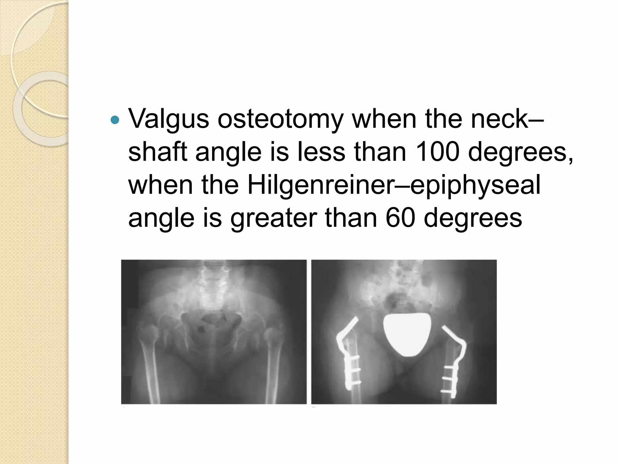  Valgus osteotomy when the neck– 
shaft angle is less than 100 degrees, 
when the Hilgenreiner–epiphyseal 
angle is greater than 60 degrees 
 